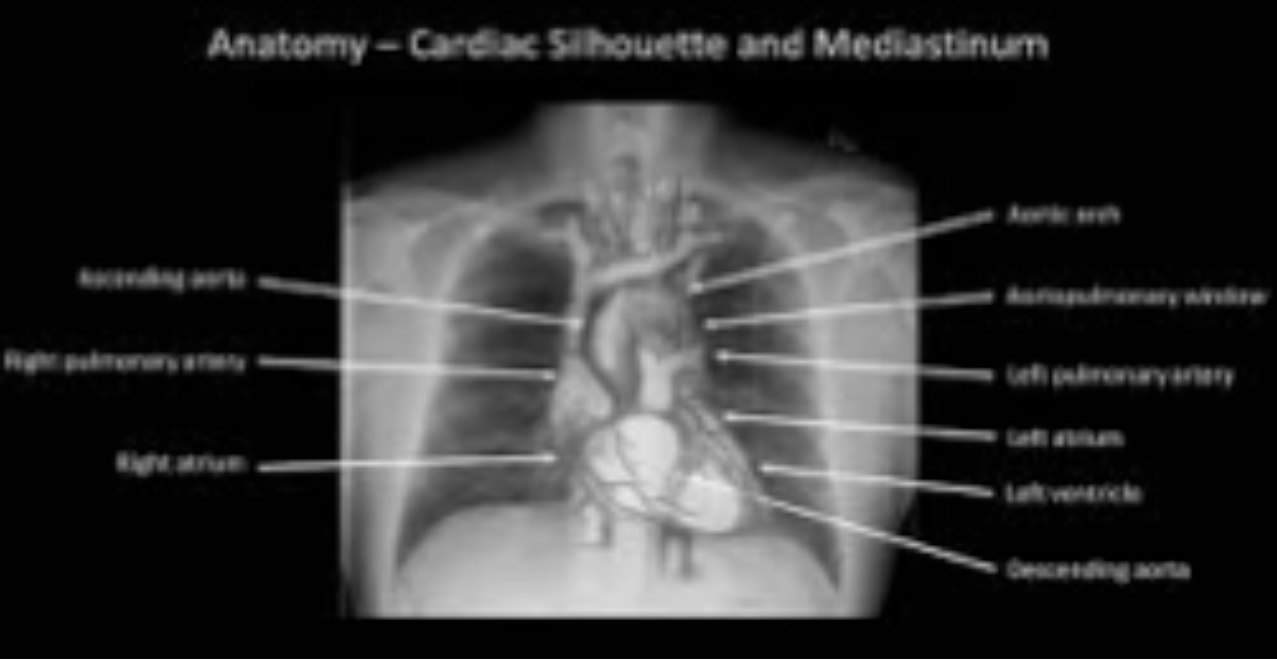 Image interpretation in radiology also involves assigning labels to an image by grouping and recognizing areas of the image that have correspondences to the radiologist’s knowledge of the underlying anatomy. (A) Most doctors can look at a chest x-ray and say, "this is the heart", "this is a rib", "this is the clavicle", "this is the aortic arch", etc. (B) This is because they know the underlying anatomy and have a basic understanding of x-ray image formation physics that relates anatomy to the image.