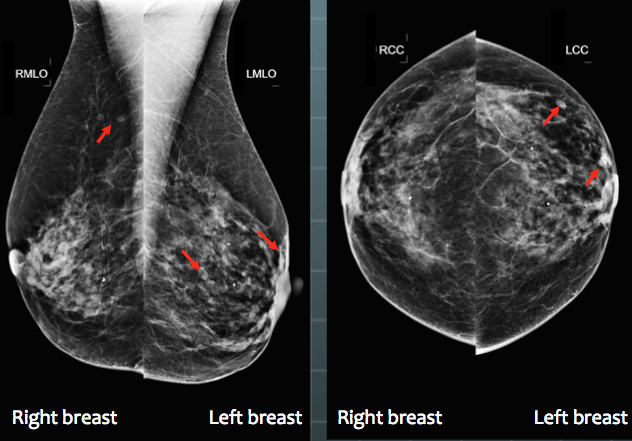 A typical 4-view display of a patient mammogram with the CAD cues (the red arrows) turned on.
